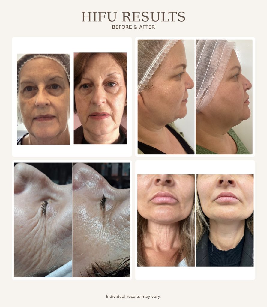 HIFU-before-after-case-study